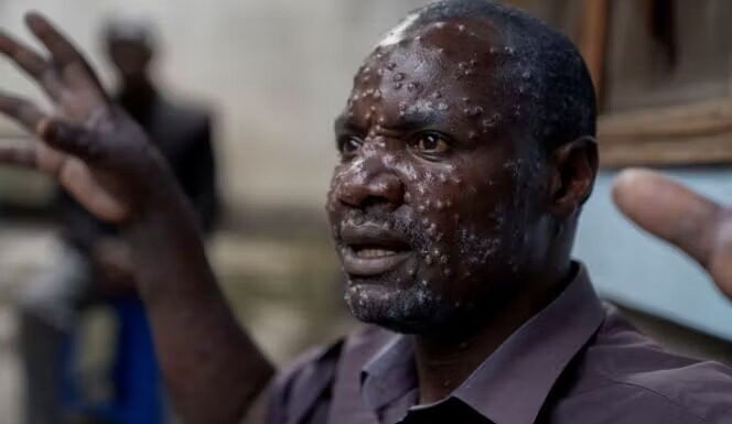 Mpox